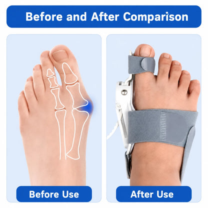 Thumb Toe Correction Orthotic Adjustable Device Vendula Care (7)